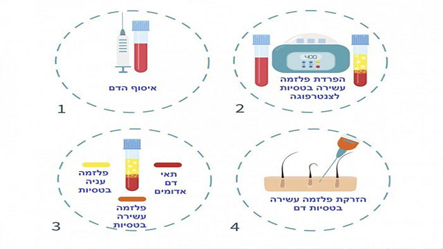 טיפול PRP – טיפול חדשני לשיער ללא תופעות לוואי במרכזי דוקטור חן