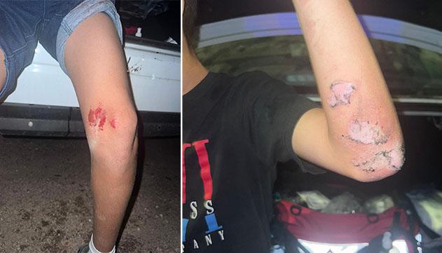 ילד בן 13 הועף על ידי רוכב אופנוע למדורת ל''ג בעומר
