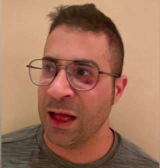 אורח במלון באילת הותקף באכזריות משום שביקש מצעיר לעטות מסכה