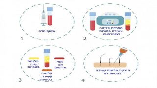 טיפול PRP – טיפול חדשני לשיער ללא תופעות לוואי במרכזי דוקטור חן
